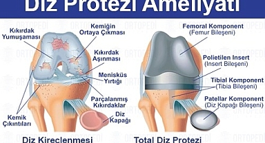 Diz Protezi Ameliyatı: Tüm Yönleriyle Kapsamlı Rehber